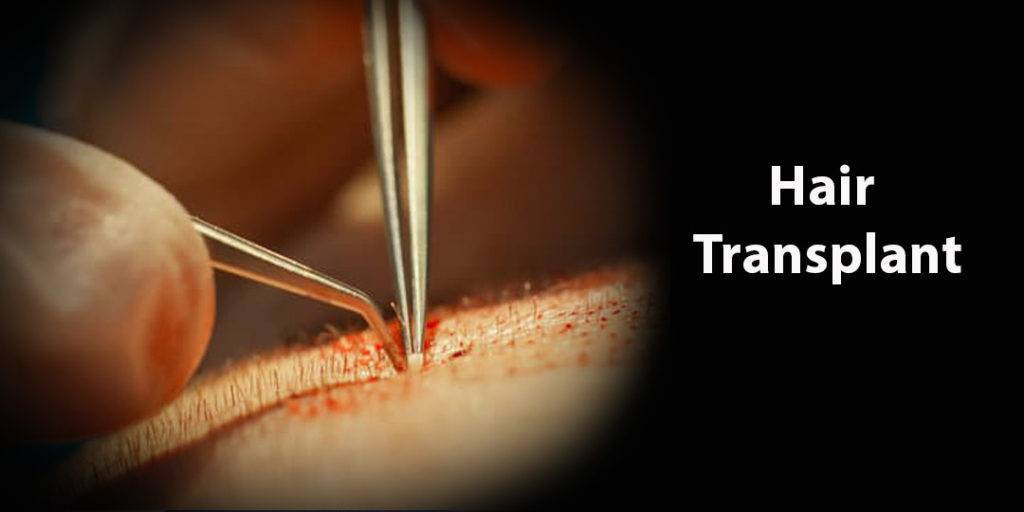 Hair Transplant Malaysia