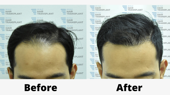 Hair Transplant Malaysia