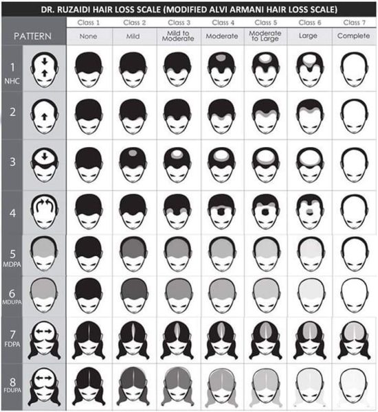 Hair Loss Scale Malaysia